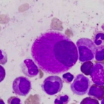 Sustancias tóxicas propician leucemias a edades más tempranas en México