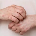 Alerta epidemiológica en México por casos de sarampión