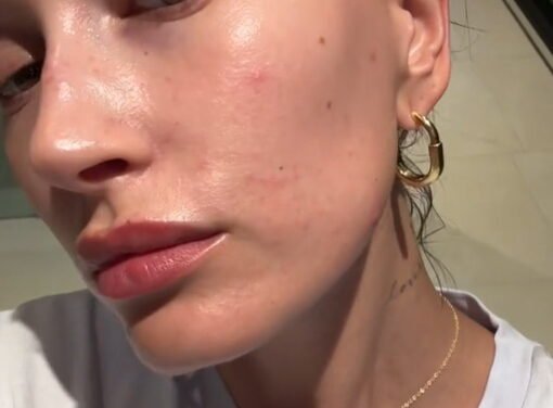 Hailey Bieber comparte sus desafíos al luchar contra una enfermedad dermatológica