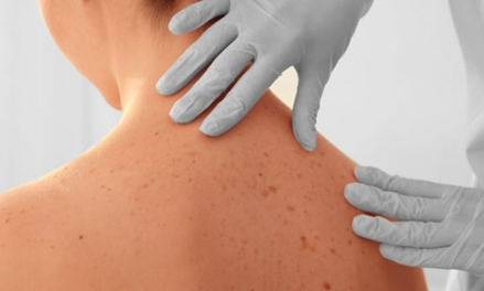 Invitan la jornada de detección oportuna por problemas dermatológicos en Torreón