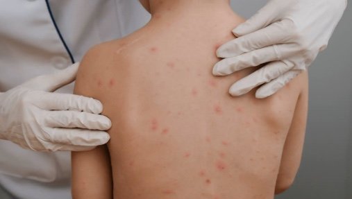 Brote de varicela en Piedras Negras afecta a más de 30 estudiantes