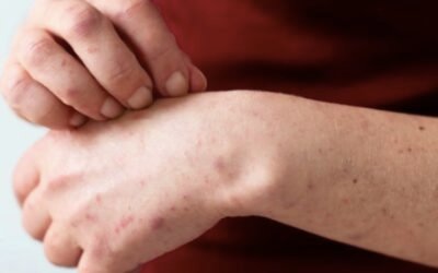 Durango en alerta por casos sospechosos de sarampión y gusano barrenador