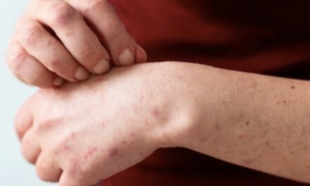 Durango en alerta por casos sospechosos de sarampión y gusano barrenador
