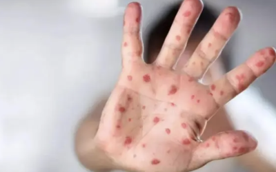 Coahuila registra 10 casos de sarampión; llaman a reforzar vacunación