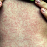 Sarampión en México: 22 estados presentan riesgo y vacunación sigue siendo insuficiente