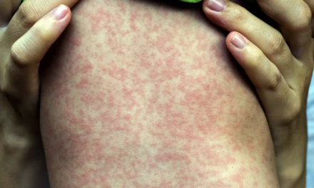 Sarampión en México: 22 estados presentan riesgo y vacunación sigue siendo insuficiente