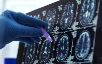 Una gota de sangre podría revolucionar el diagnóstico temprano del alzhéimer